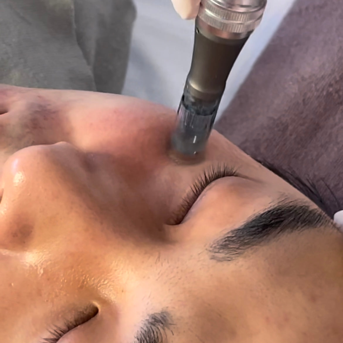 Micro needling - Pores solution