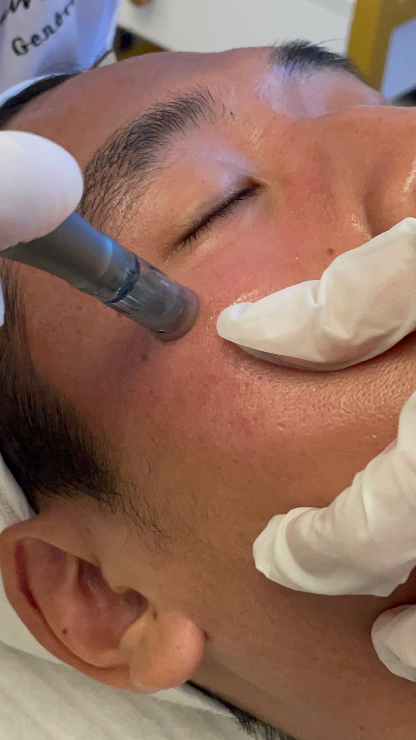 Micro needling - Pores solution