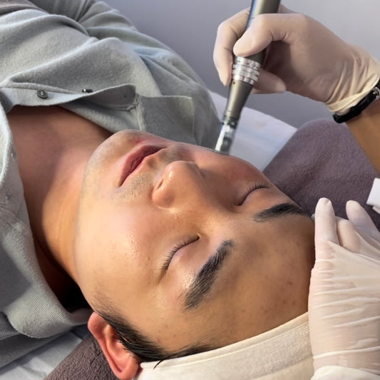 Micro needling - Pores solution